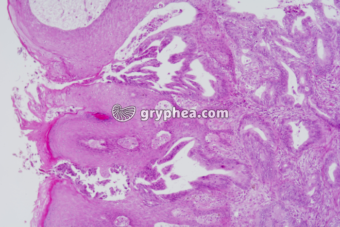 Cancer du rectum x25 - gryphea.org